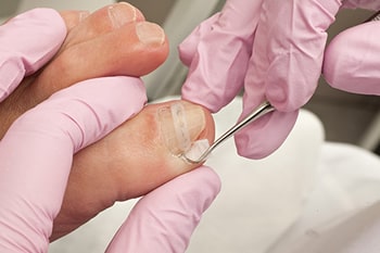 Jessie performing sterile ingrown toenail care on a big toe, gently lifting a thin nail spicule with a scalpel; close-up of gloved hands